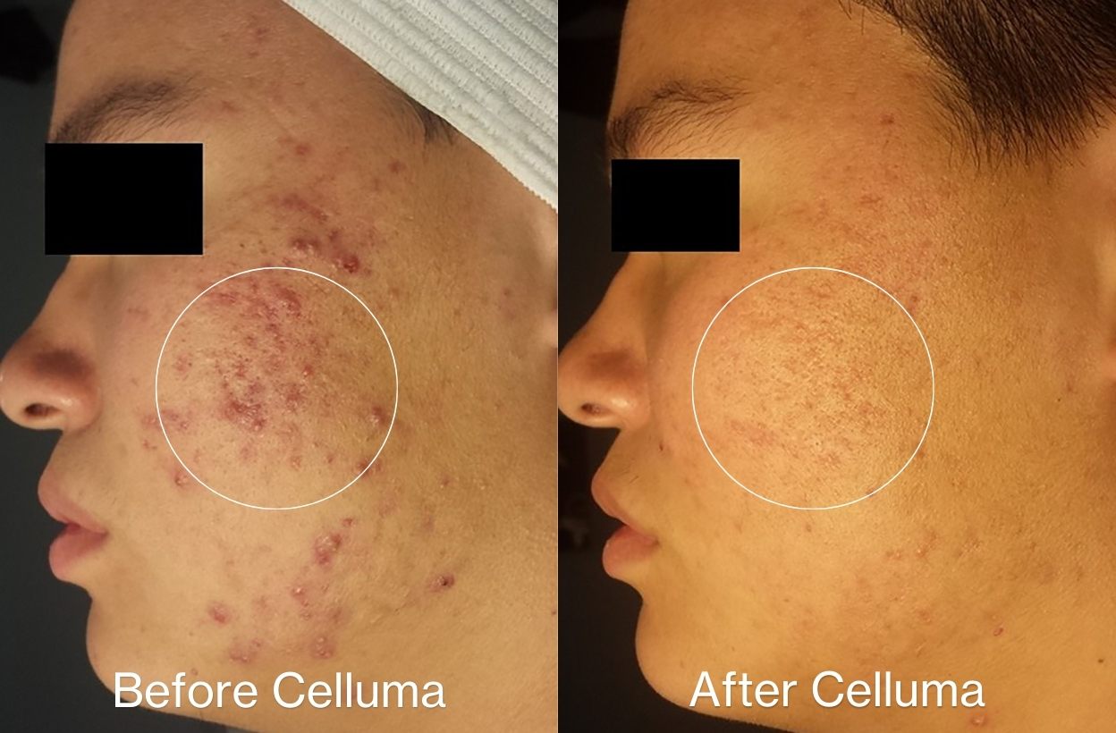 Celluma PRO PLUS | 4-Mode LED Red Light Therapy Device
