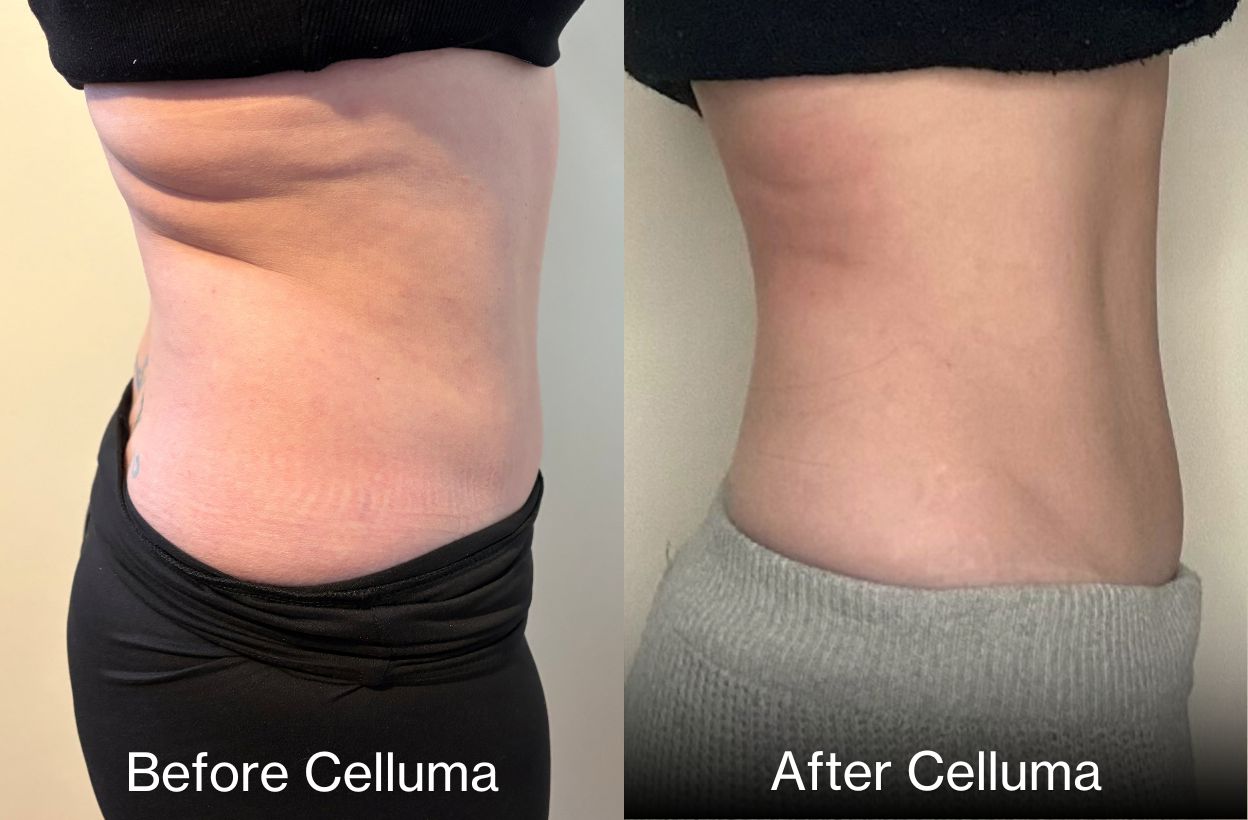 Side photo of woman's midsection who received 6 treatments with Celluma light therapy for body contouring. She lost a half inch of her waist, a half inch of her hips, smoother skin, and relief from lower back pain.
