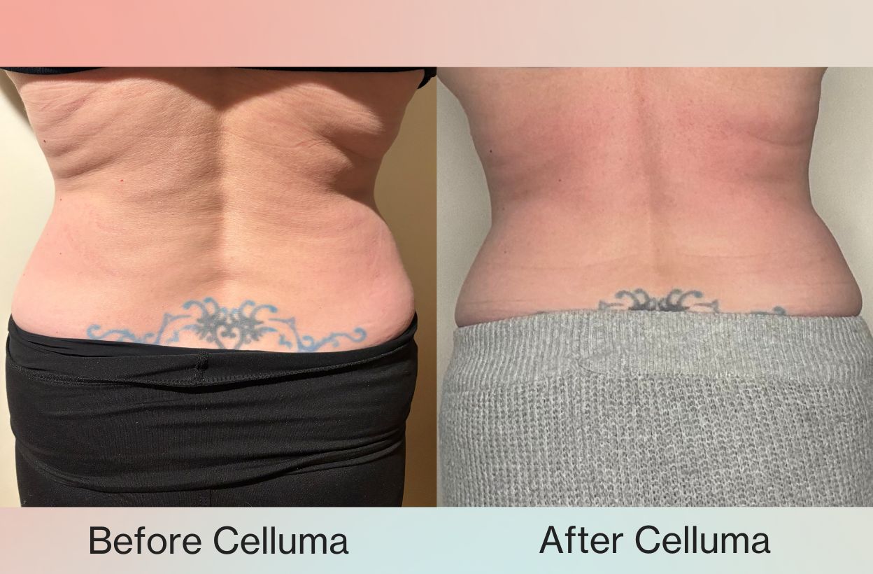 Back photo of woman's midsection who received 6 treatments with Celluma light therapy for body contouring with red light and near infrared light. She lost a half inch of her waist, a half inch of her hips, smoother skin, and relief from lower back pain.