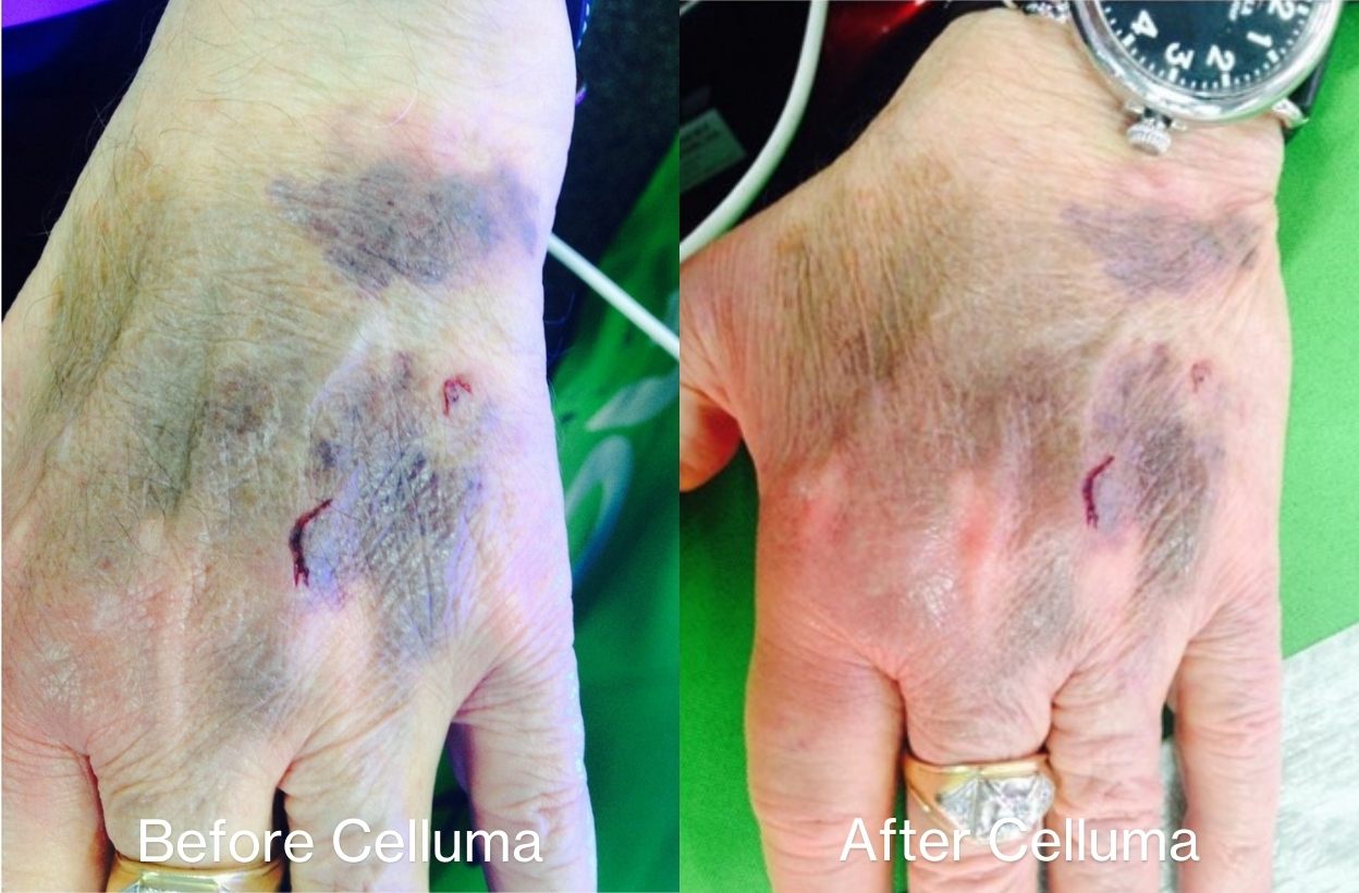 Before and after image of a hand of a man with bruising. After results show after just one 30 minute Celluma treatment.