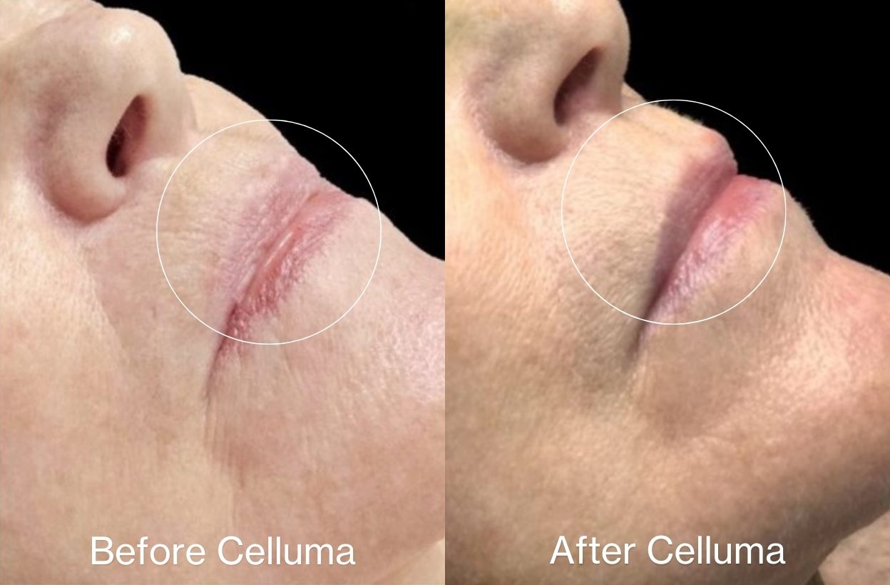 LED red light therapy for aging before and after photos. Photos show a side profile of a woman's face with reduced fine lines and wrinkles along with improved texture of the skin red, near-infrared, and blue light therapy. Protocol was 30 minutes, 3 times per week, for 4 weeks. After photo was taken 8 weeks post treatment.