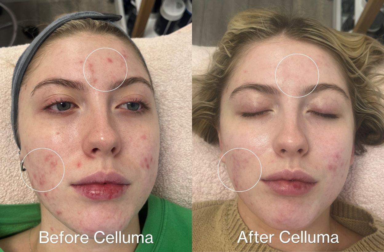 LED light therapy for acne before and after photos.  Image shows a woman with enhanced complexion, reduced acne, and overall improvement of skin appearance with blue light and red light therapy. Protocol was 3x per week for 4 weeks.