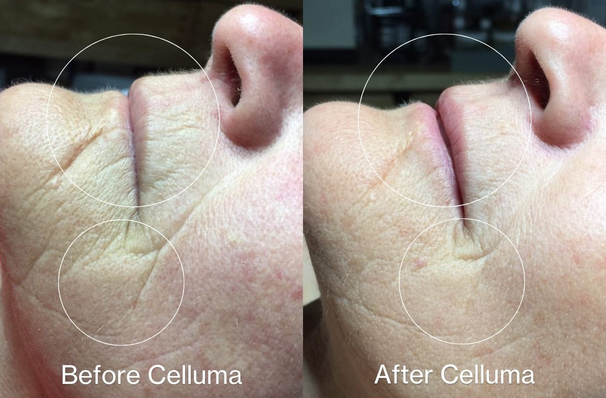 Before and after image of a women who used the Celluma PRO red light therapy on her face to treat wrinkles on wrinkles mode. 