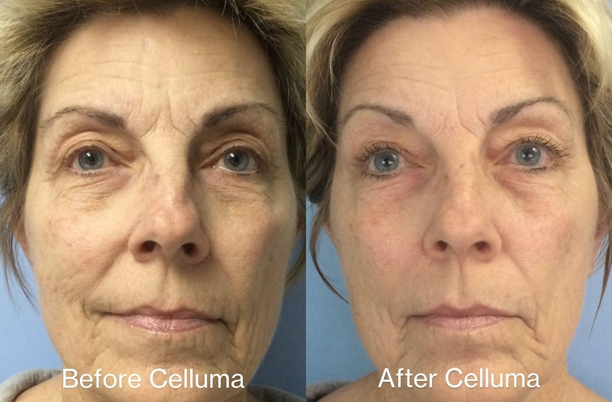 Before and after images of a women's full face showing dramatic improvement in the skin's overall texture, firmness, and appearance with the use of Celluma LED light therapy. After photo taken 12 weeks post treatment following a protocol of three 30-minute treatments per week for 4 weeks.