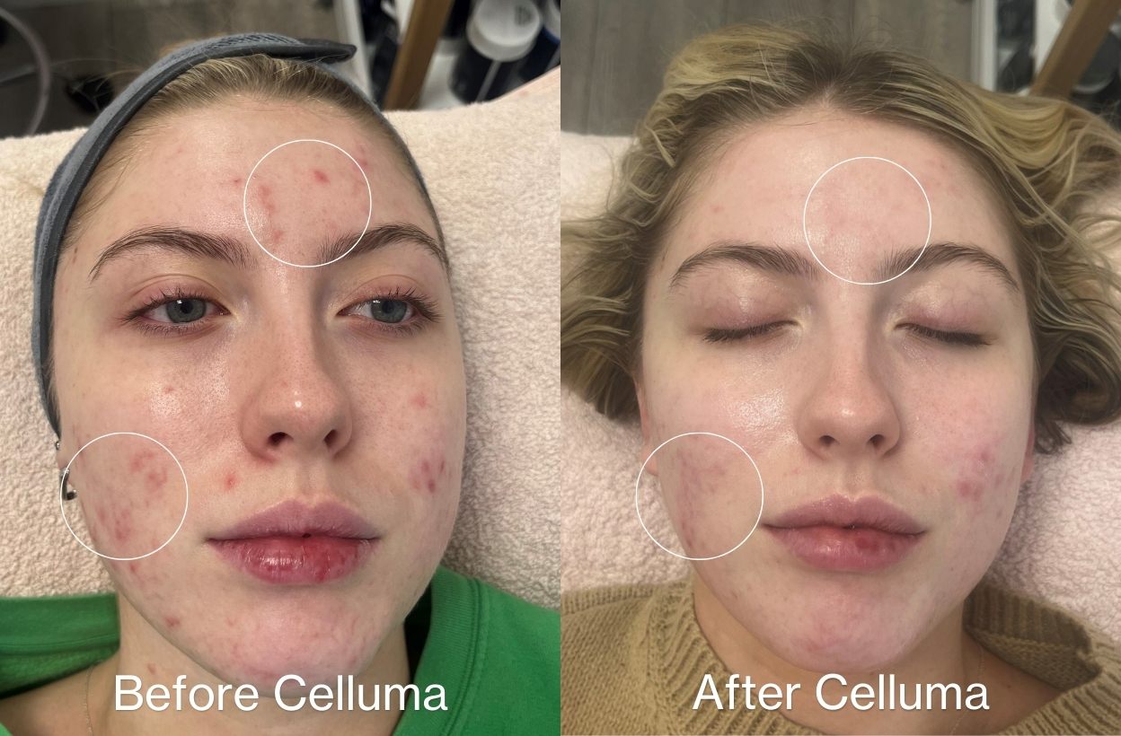 LED Red Light Therapy Machine for Professionals | Celluma ELITE