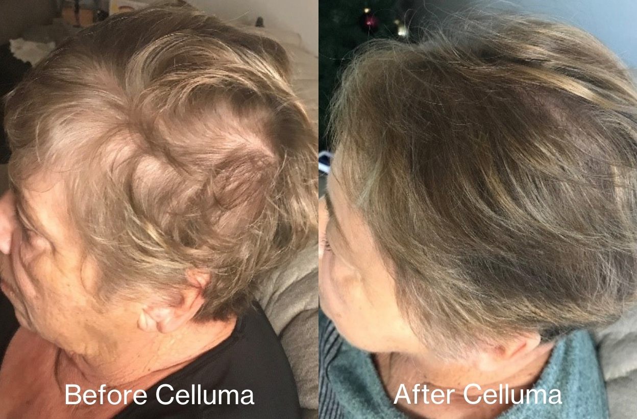 Before image (left) and after image (right) of a woman's scalp showing a thicker head of hair and increased hair growth following treatment with Celluma RESTORE red light therapy. Treatment was 30 minutes, every other day for 16 weeks.