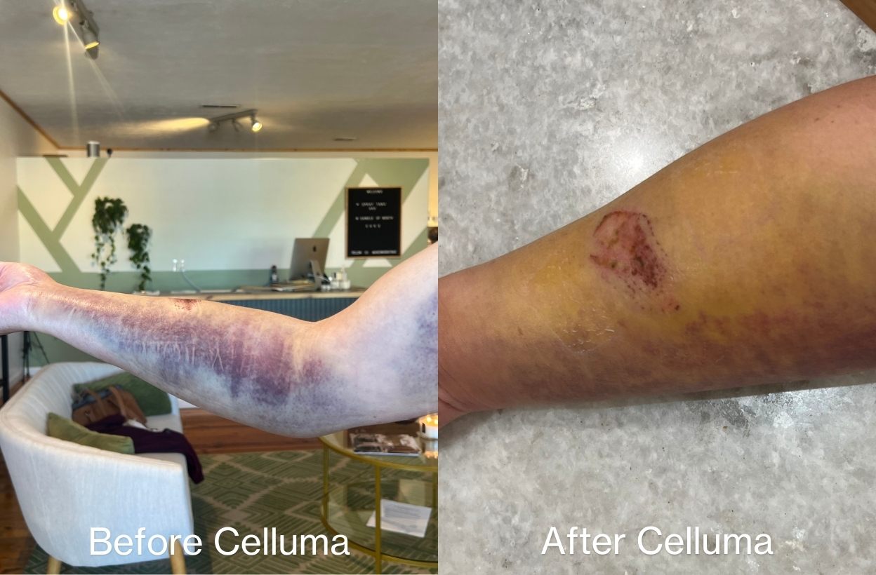 Before and after image of a woman's arm showing improvement in the appearance of bruising after receiving LED red light therapy treatments for pain. Pain treatments were 30 minutes, 2 times a day, for 6 days.