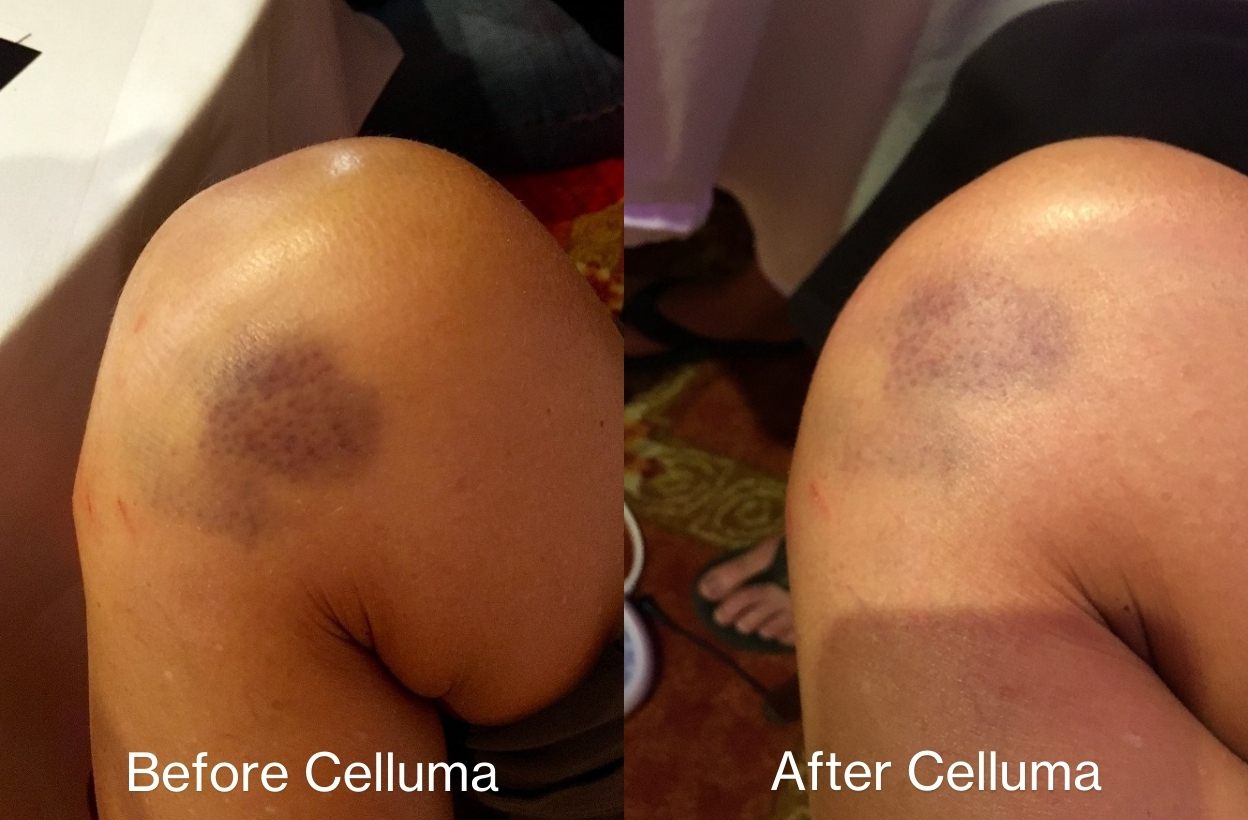 Before and after image of a Celluma user who used their device on Pain mode to treat their bruising on their leg/knee.