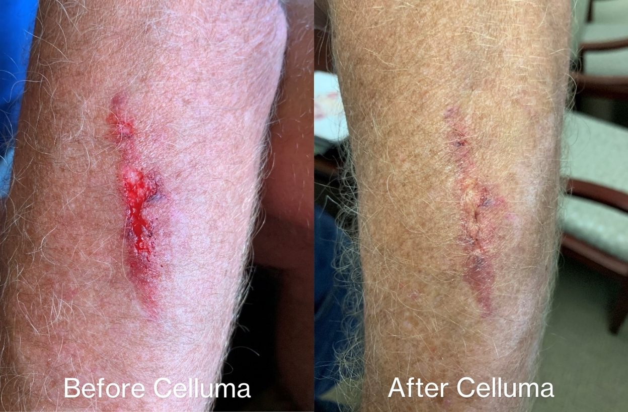 Before and after results of a man who used pain mode on his leg after a fall.