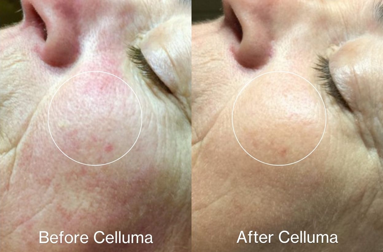 Women showing a side profile before and after image after she used the Celluma on Aging mode.