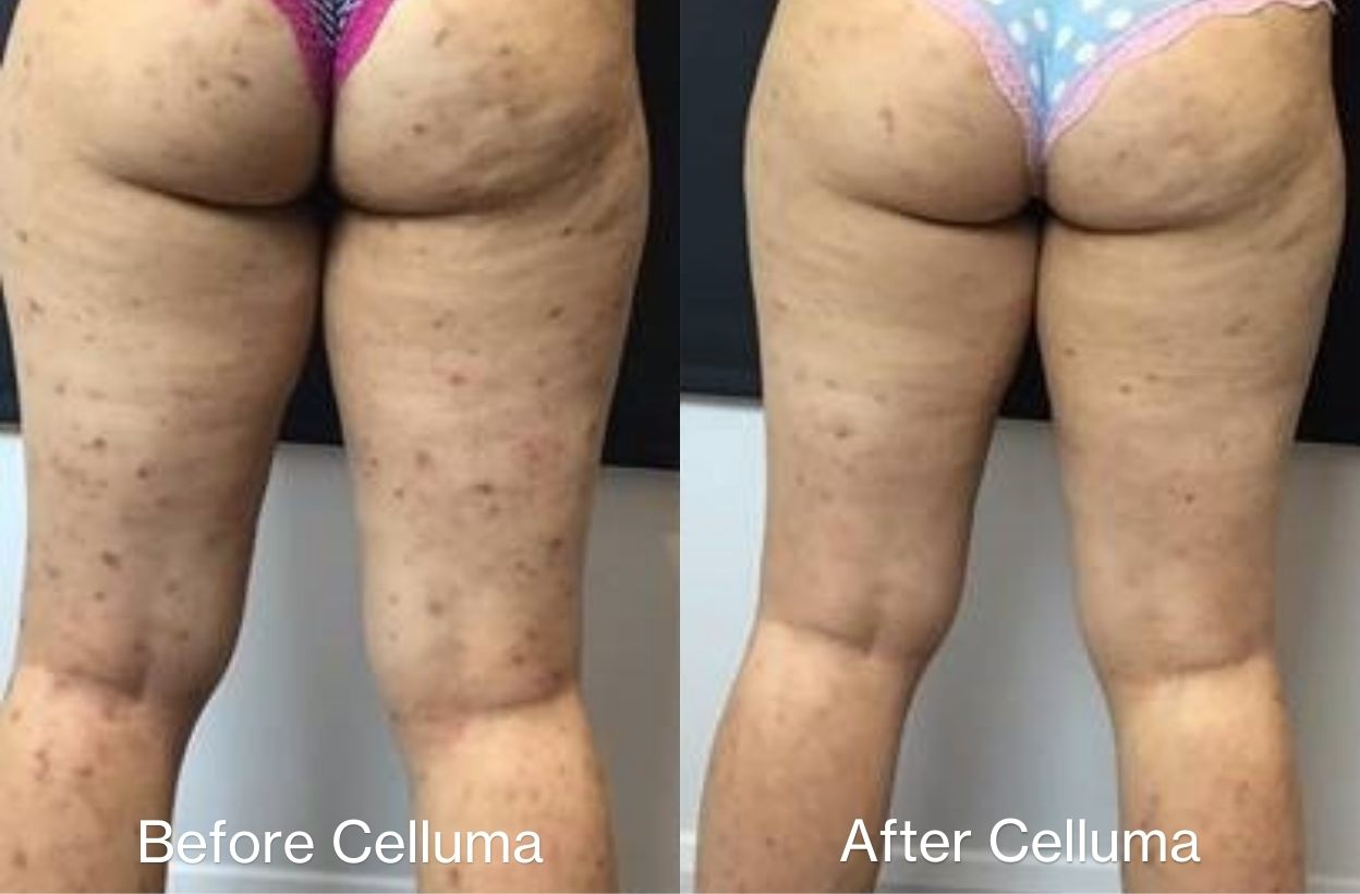 Red light therapy for acne treatment before and after photos.  Shows a women with reduced acne lesions on the thighs and buttocks. Treatment was with the Full-body Celluma DELUX on acne mode.