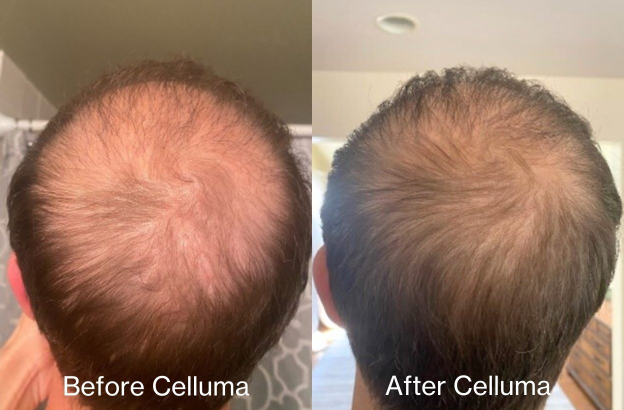 Before and after images of a man with used the Celluma RESTORE red light therapy for hair growth on the top of his head. After photo (right) shows results of new hair growth on the crown of the scalp after 12 weeks of treatment.