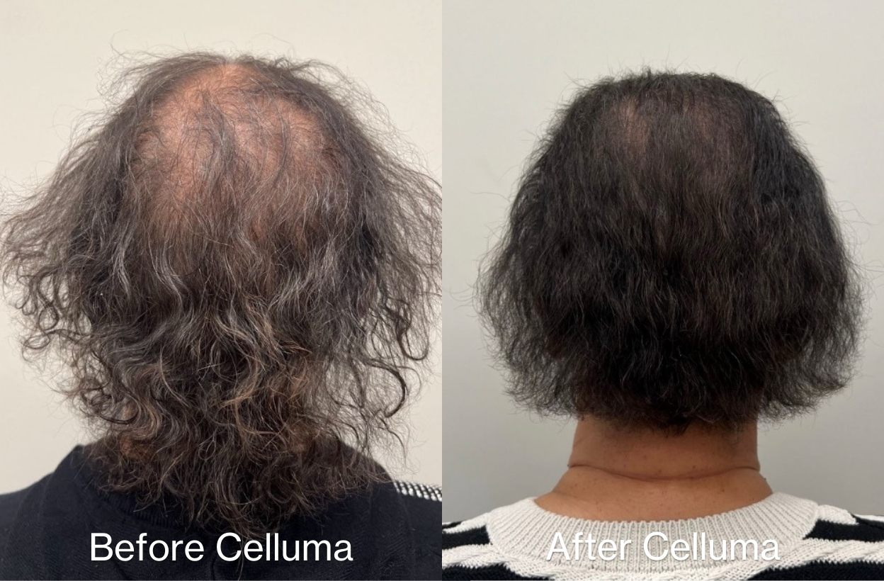 Before image (left) and after image (right) of a woman's scalp showing a thicker head of hair, increased hair growth, and darker hair following treatment with LED red light therapy. Treatment was with the Celluma RESTORE for 3 months with a hair density serum by Monpure.