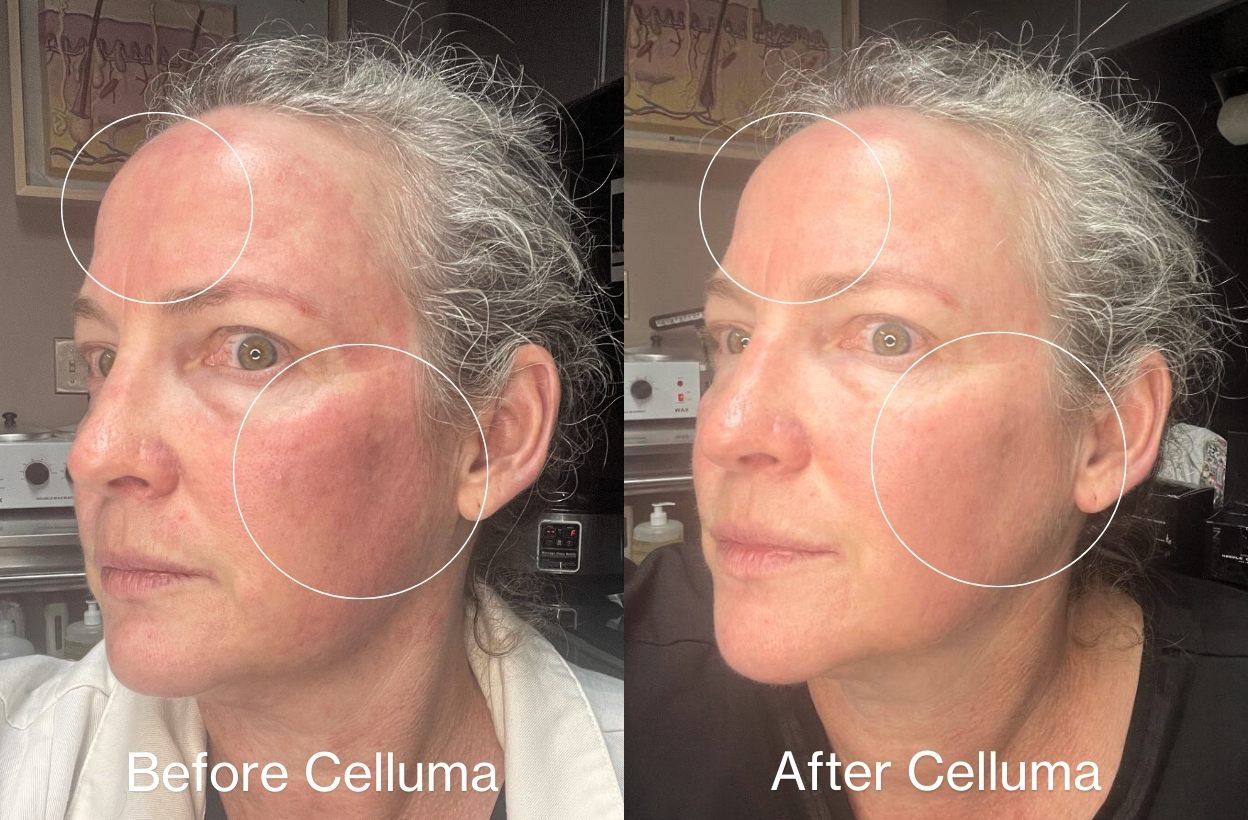 Before Celluma (left) and after Celluma (right) depicting a woman's face after 1 treatment with red light therapy that shows a reduction in redness and overall improvement in the texture and appearance of the skin.