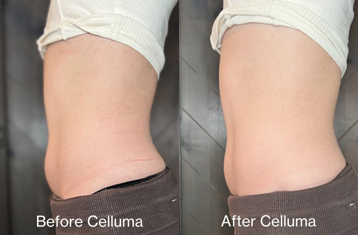 Before (left) and after (right) images of a woman's mid section after one Celluma CONTOUR light therapy treatment showing a visible reduction in the circumference in the waistline and belly.