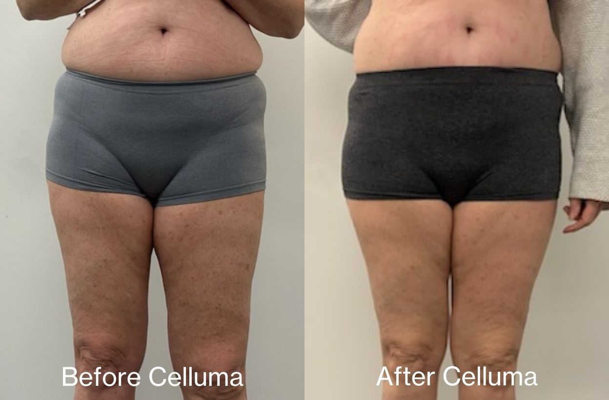 Body contouring before and after images of woman (facing to camera) from a Celluma study showing reduction in the circumference of hips, waist, and thighs after 4 weeks treatment with red and near-infrared LED light therapy. Results after 4 weeks, treating 3 times per week for 30 minutes. Device used was the Celluma CONTOUR System.