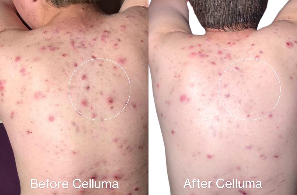 Blue light therapy for acne treatment before and after photos.  Shows a man with improved back acne who used the full-body DELUX on his back. After photo is one week after a single treatment.