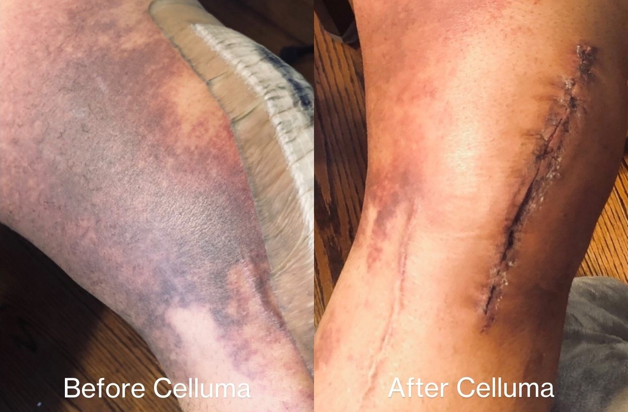 Before and after image of a woman's knee, post-surgery, showing an overall improvement in the appearance of inflammation and bruising after one Celluma LED light therapy treatment using pain mode.